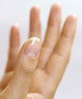 заболевания ногтей или чем болеют ногти