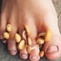 грибковые инфекции ногтей (микозы)